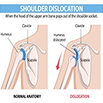 Shoulder Dislocation in Athletes: When Is Surgery the Right Call?