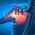 Shoulder Impingement vs. Rotator Cuff Injury: Key Differences