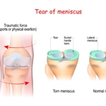 Top 3 Patient Benefits after Meniscus Surgery
